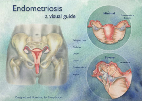 Gynaecology Surgery